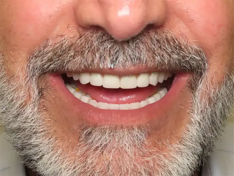 After: a failing denture replaced with a full-mouth implant restoration