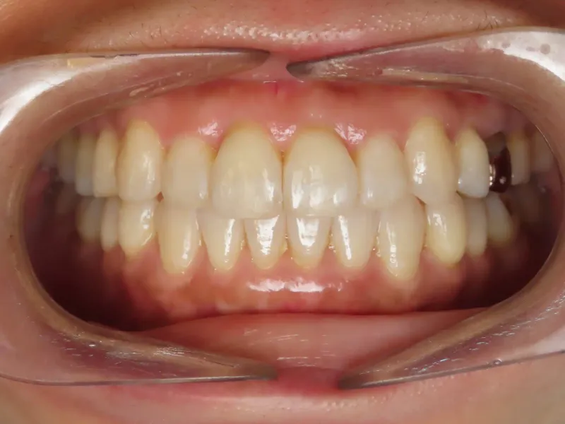 After: an anterior crossbite corrected with Invisalign