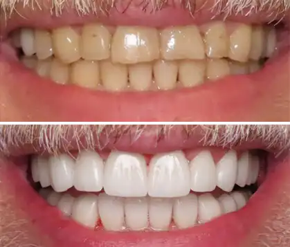 Teeth before and after cosmetic whitening
