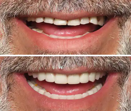 A smile before and after dental implants