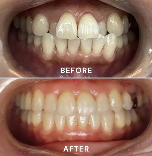 Crowded, uneven front teeth before Invisalign, and the same teeth straight and even after
