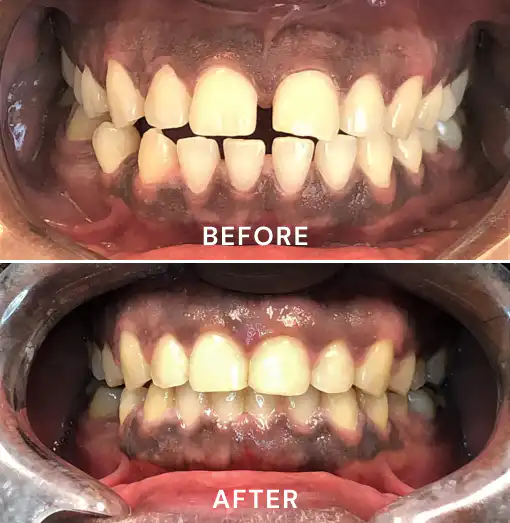 Gapped front teeth before Invisalign, and the same teeth with the gaps closed after