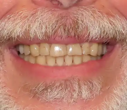 Worn, yellowed teeth before veneers