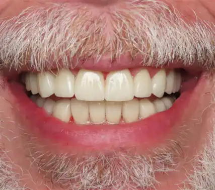 The same smile after veneers: straight, white teeth