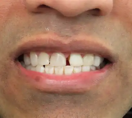 A smile with chipped, gapped front teeth, before porcelain veneers