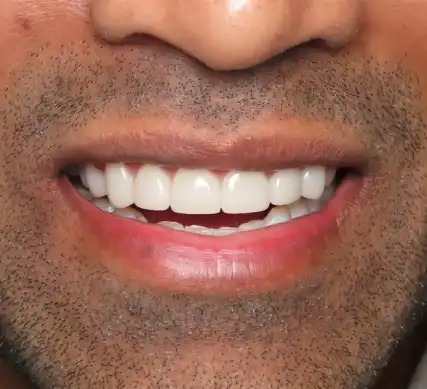 The same smile after porcelain veneers: even, bright front teeth
