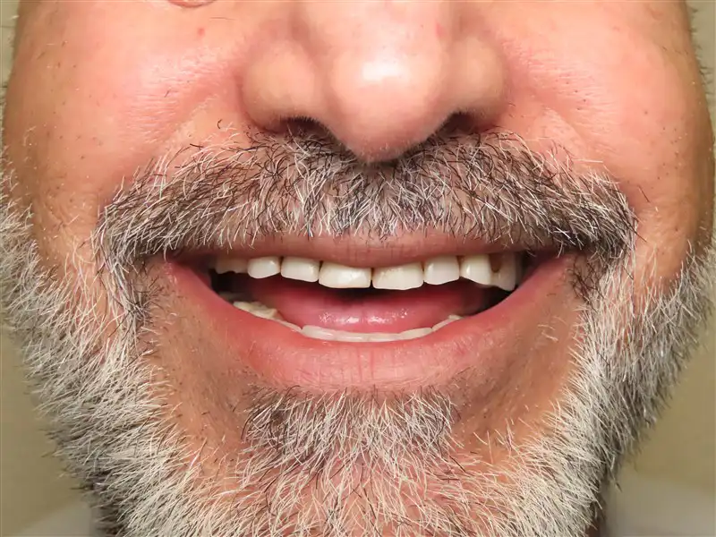 IMPLANT-FULL-MOUTH-Before