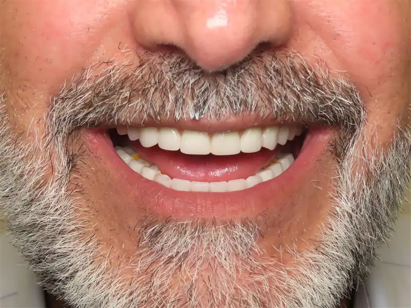 IMPLANT-FULL-MOUTH-after