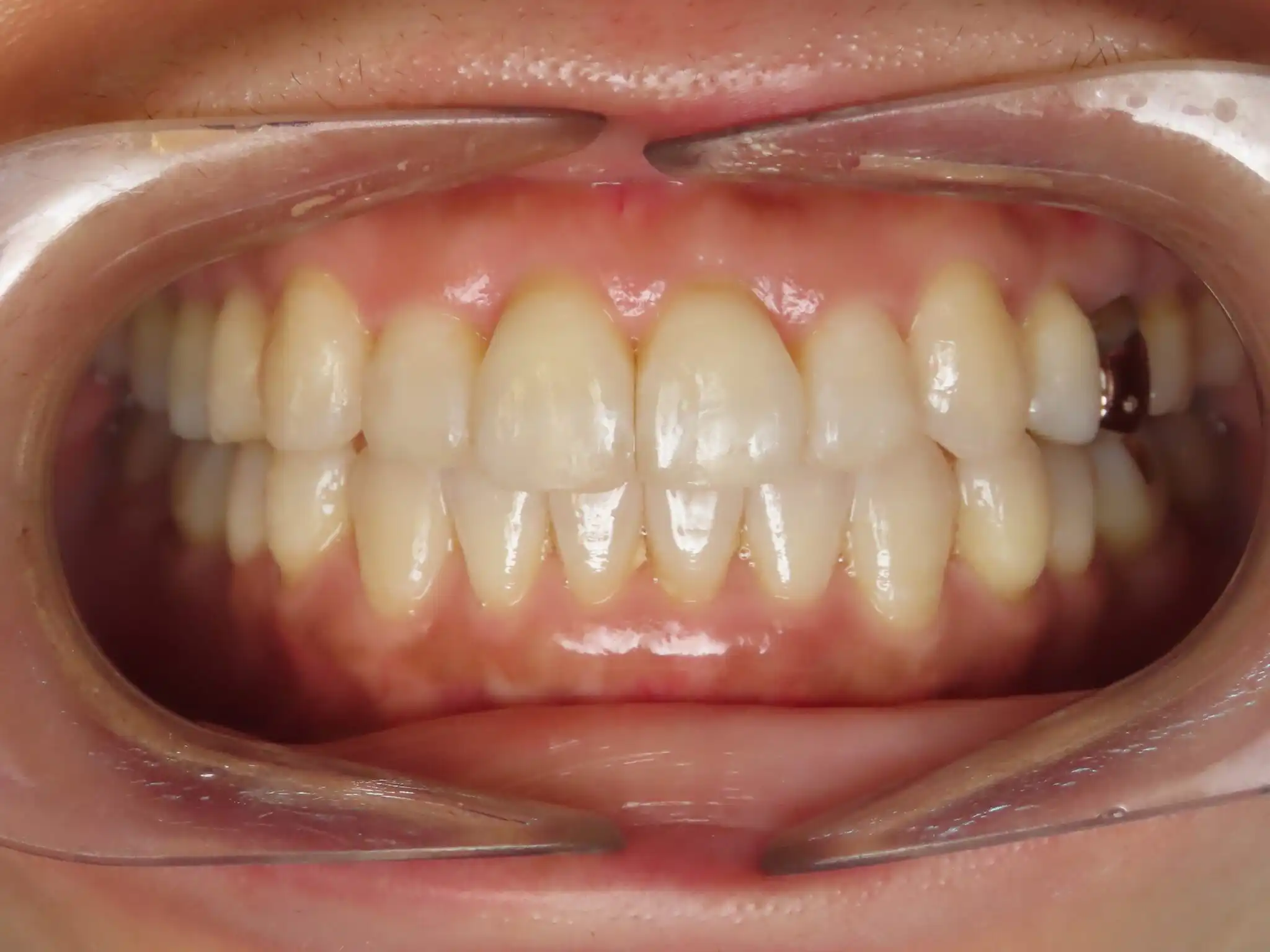 Invisalign-Case-1-ANT-CrossBite-Invisalign-After-2048x1536