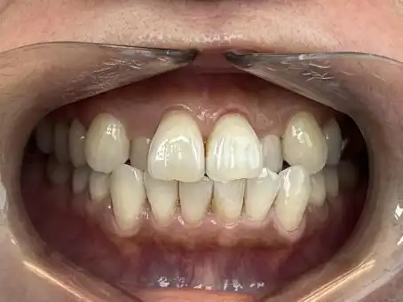 Invisalign-case-1-ANT-CrossBite-Invisalign-Before