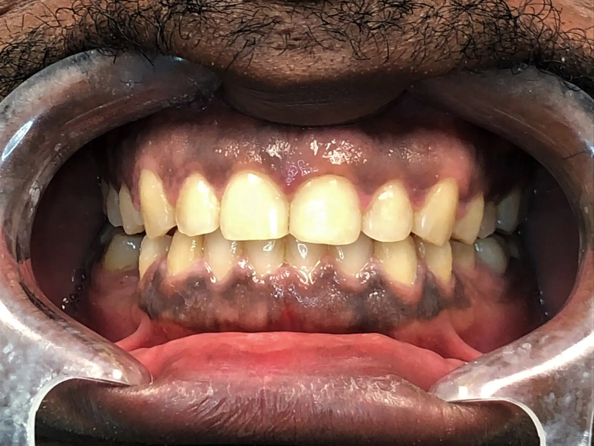 Invisalign-case-2-after-2048x1537
