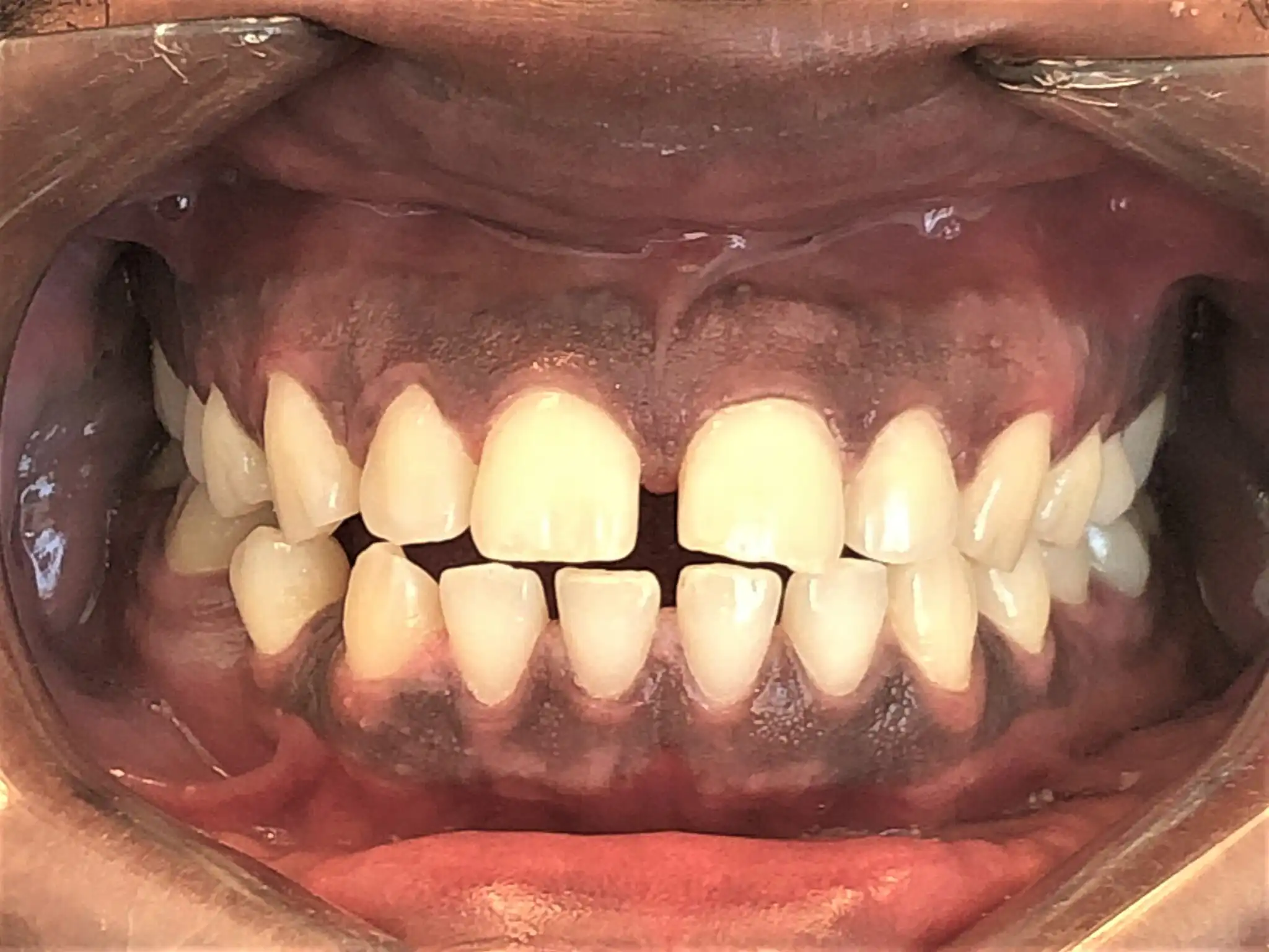 Invisalign-case-2-before-2048x1536