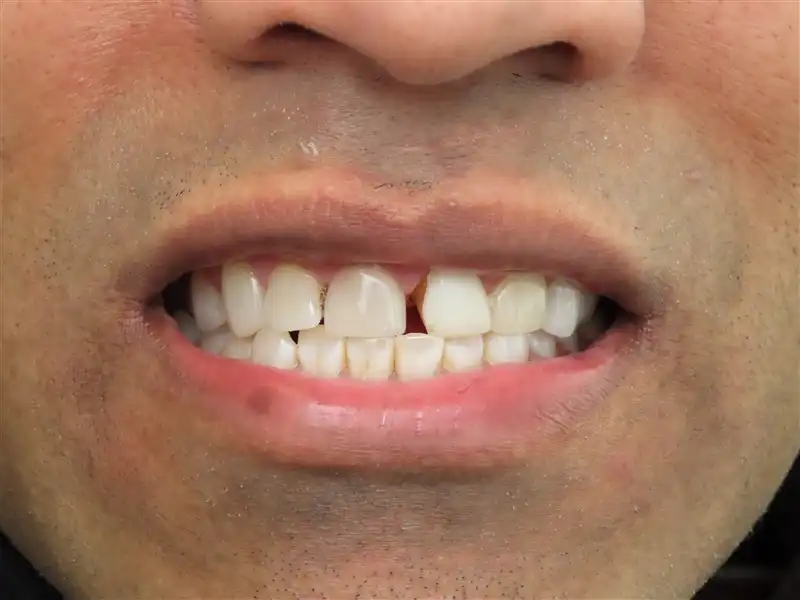 Smile-Design-1-Before