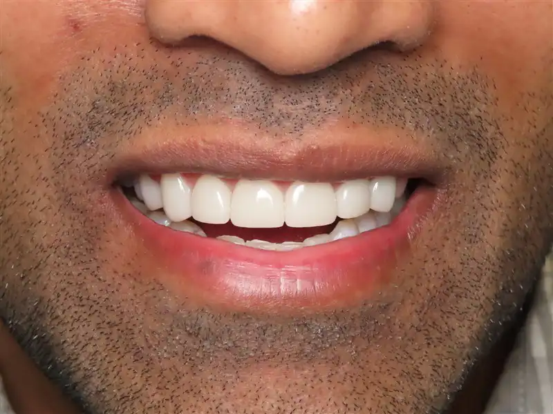 Smile-Design-1-after