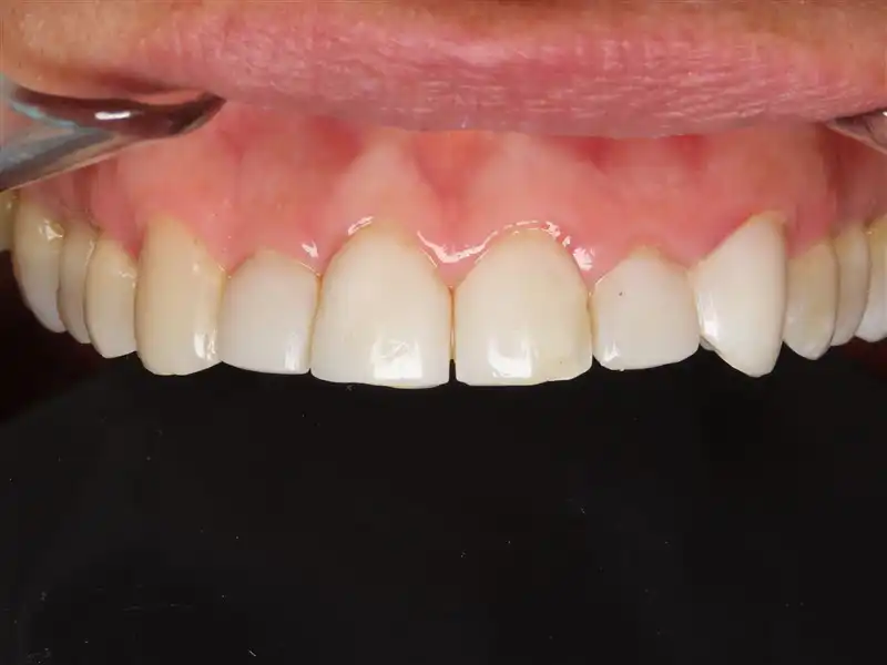 Smile-Design-3-4veneer-Before