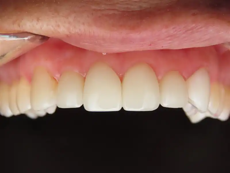 Smile-design-3-4veneer-after