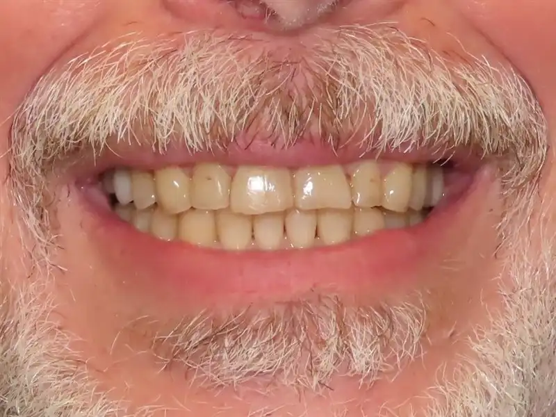 smile-design-2-Before