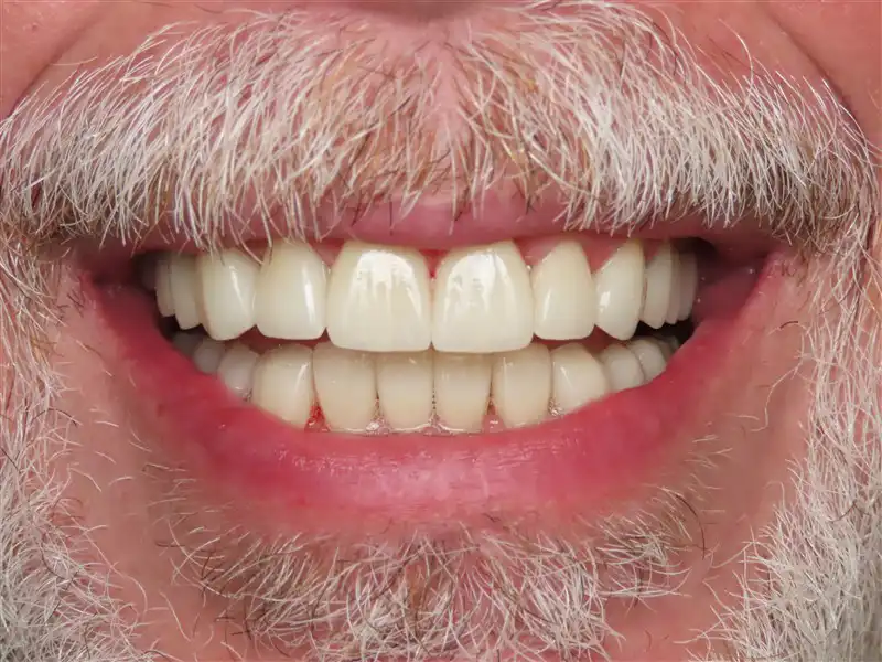 smile-design-2-after